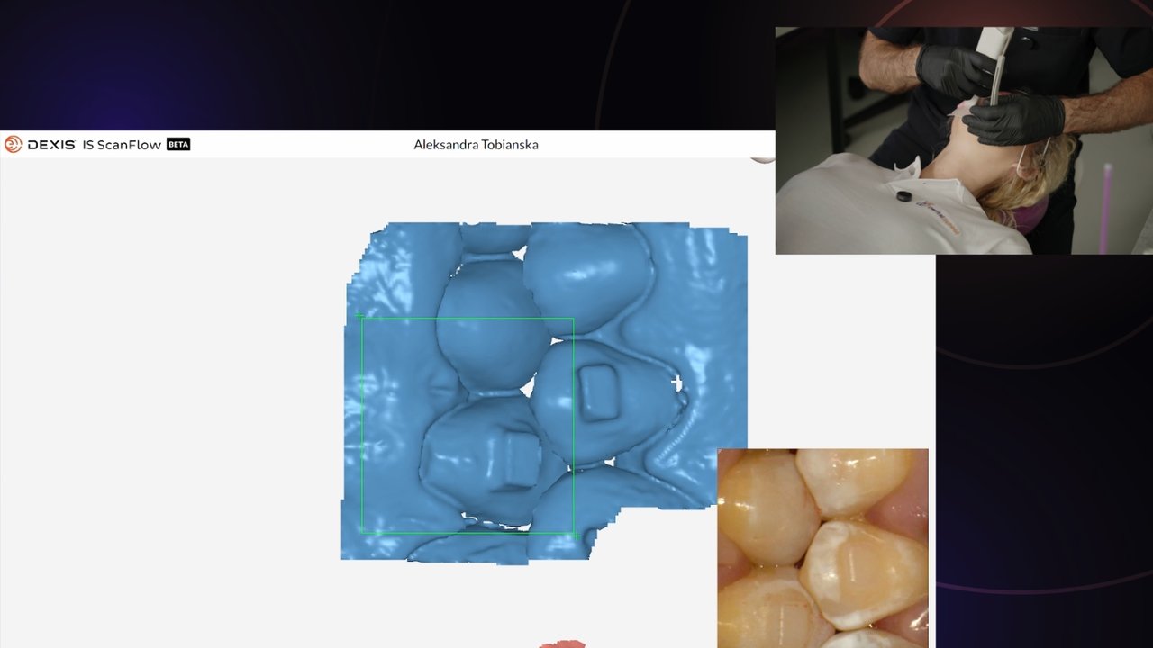 Cyfrowa kontrola okluzji - kontakty zwarciowe na skanie 3D